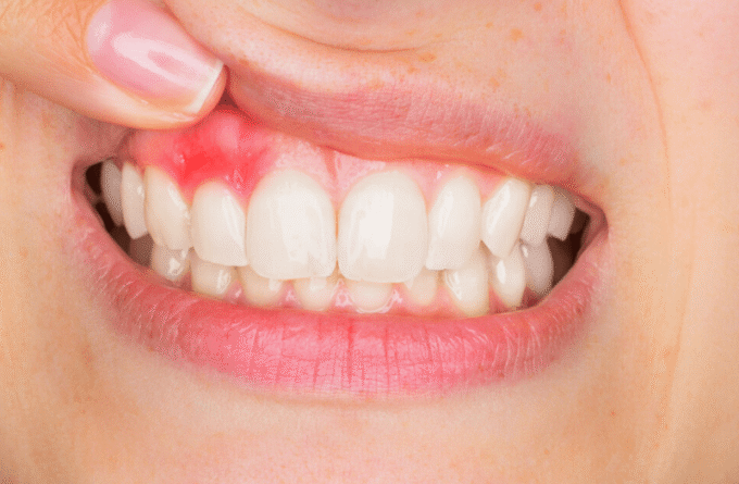 Die Parodontologie befasst sich mit dem Zahnfleisch – Ihr Experte in Köln ist für Sie da.