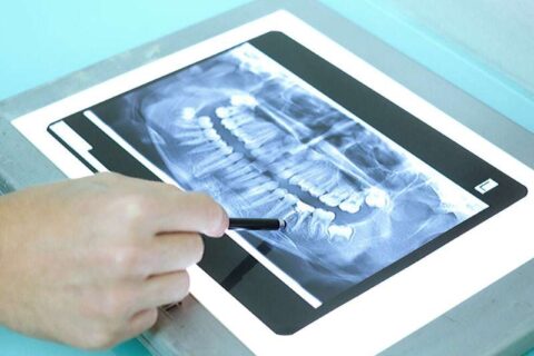 Oralchirurgie in Köln: Röntgenaufnahme als Grundlage für Ihre Behandlung