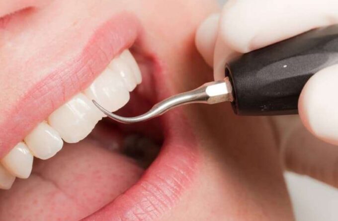 Als Teil unserer Leistungen im Bereich der Parodontologie führen wir in unserer Praxis in Köln eine gründliche Untersuchung des Zahnfleisches durch.