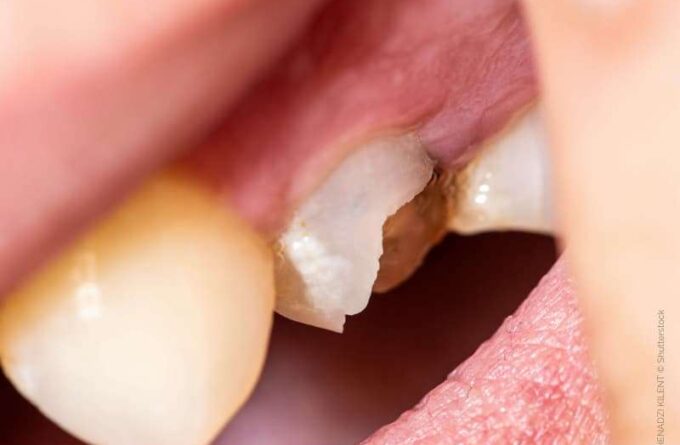 Zahn abgebrochen, Blick in den Mund