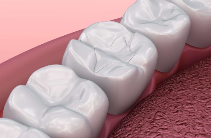 Fissuren in Backenzähnen versiegelt